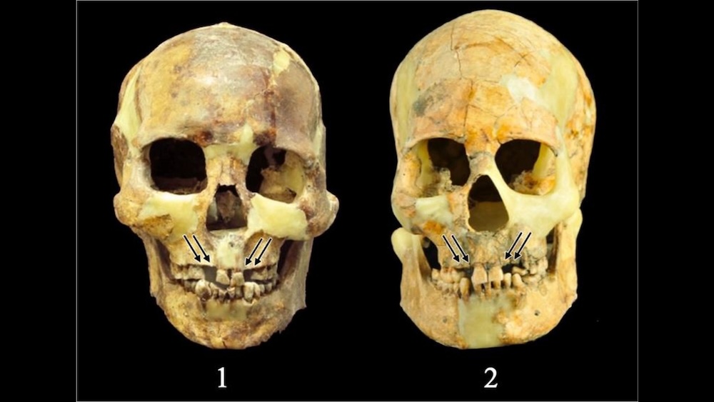 研究发现，台湾古代人类为了“审美表达”和“勇气测试”而从嘴里拔掉健康的牙齿